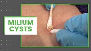 Milium Cysts  Dr Derm [upl. by Adamok]