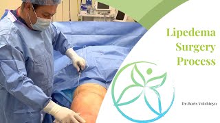 Lipedema Surgery Process  Lipedema Treatment NJampNY  Dr Boris Volshteyn [upl. by Arianna662]