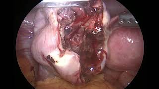 hemorrhagic ovarian cyst [upl. by Yllom]