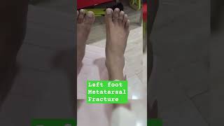 LETT FOOT METATARSAL FRACTURE [upl. by Anatole614]