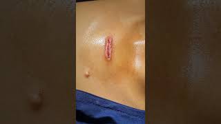 Keloid removal in 30 minutesFive monthly chemotherapy given to control recurrenceCall9700020802 [upl. by Susette994]