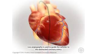 ANGIOPLASTICA CORONARICA PCI O PTCA [upl. by Nodababus]