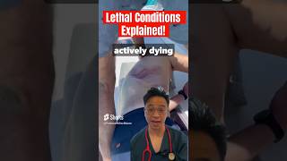 Lethal Conditions Explained  Flail Chest medicine doctor surgeon emergency [upl. by Keever107]