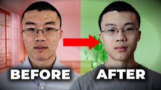 How I Cleared My 7 Year Old Acne  What FINALLY Worked [upl. by Kitti]