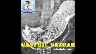 Gastric Bezoar CausesSymptoms and signs Diagnosis Bezoar Removal Endoscopic SurgicalNo1doctor [upl. by Idok717]