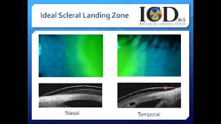 Scleral Contact Lenses Video 5 [upl. by Viddah727]