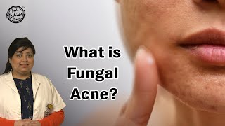 What is Fungal Acne  How to Get Rid of Fungal Acne  Fungal Acne Treatments  Dr Nivedita Dadu [upl. by Dugaid]