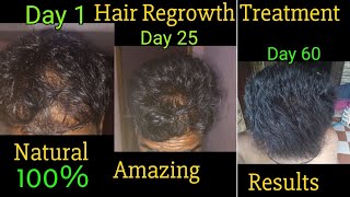 Amazing result hair regrowth new natural treatment [upl. by Henigman454]