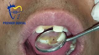 चोट लागेर कालो हुदै गएको दाँतको उपचार।Fractured discoloured tooth treatment [upl. by Oiluig]