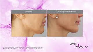 profound rf microneedling [upl. by Odareg]