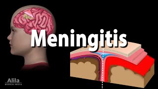 Meningitis Pathology Causes Symptoms Diagnosis and Treatment Animation [upl. by Phyllys]