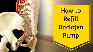 How To Refill Baclofen Pump  Tricumed Pump [upl. by Birkner]