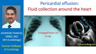 Pericardial effusion Fluid collection around the heart [upl. by Anais]