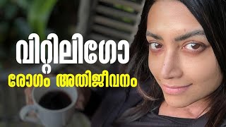 ചർമ്മത്തിലുണ്ടാകുന്ന വിറ്റിലി​ഗോ രോ​ഗം എന്താണ്   Mamta Mohandas  Vitiligo treatment [upl. by Tobi]