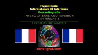 Échocardiographie  Hypokinésie Inférolatérale Et Inférieure [upl. by Sueaddaht288]