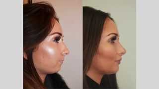 Rhinoplasty Review Selfie amp Testimonial [upl. by Amund]