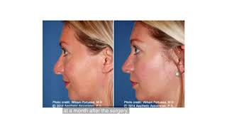 Removing a Bulbous Tip  Nose Surgery and Recovery [upl. by Notsla]