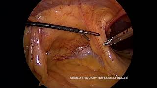 CME amp CVL FOR HEPATIC FLEXURE CA WITH VOICE [upl. by Leiand]