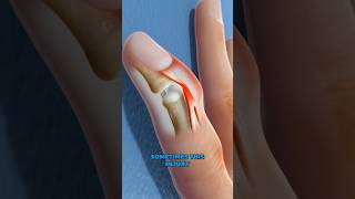 What is mallet finger 3D Animation [upl. by Fanchie]