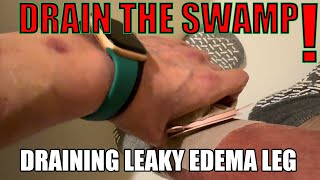 DRAIN THE SWAMP leaky leg edema drainage DIY trick to stay clean and dry w OSTOMY BAG LEFT LEG [upl. by Aynotan270]