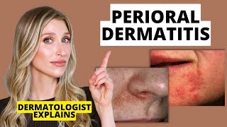 Dermatologist Explains Perioral Dermatitis What it Looks Like Causes amp Treatments  Dr Sam Ellis [upl. by Deeann]