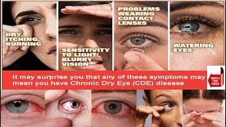 DRY EYE SYNDROME  PATIENT EDUCATION AND INFORMATION  CAUSES SYMPTOMS TREATMENT [upl. by Kehsihba]