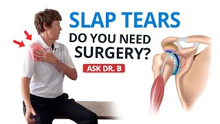 Shoulder Labral Tear  SLAP Lesion Do You Need Surgery Ask Dr B [upl. by Ecinue]