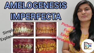 AMELOGENESIS IMPERFECTA  DEVELOPMENTAL DISTURBANCES IN STRUCTURE OF TEETH [upl. by Trudey]