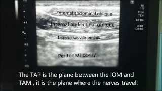 USguided Rectus Sheath Block [upl. by Coleman]