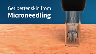 How Microneedling Improves Skin Firmness and Complexion Collagen Induction Therapy [upl. by Hakaber]