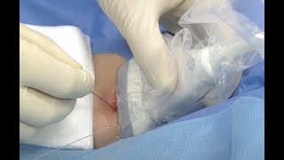 Brachial artery line insertion [upl. by Crain]