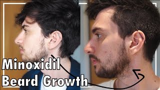 Minoxidil Beard Growth Three Months [upl. by Costanzia]