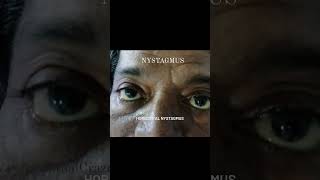 NYSTAGMUS  HORIZONTAL NYSTAGMUS eye ophthalmology [upl. by Hersch102]