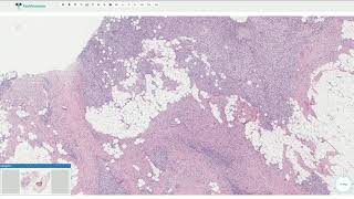 Fibrous Hamartoma of Infancy  Histopathology [upl. by Fahland445]