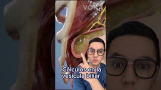 Cálculos en la vesícula biliar colelitiasis  Dr William Guerrero medicina shorts [upl. by Rolyat667]