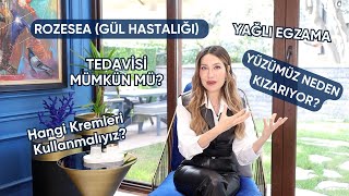 Yüzüm neden kızarıyor  Rozasea Gül Hastalığı Tedavisi Nedir Dr Cansu Şahin [upl. by Niatsirk63]