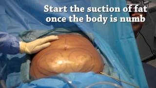 How is liposuction performed  Centre for Surgery [upl. by Caspar]