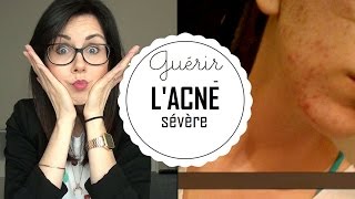 Lacné sévère  en guérir naturellement [upl. by Aretta]