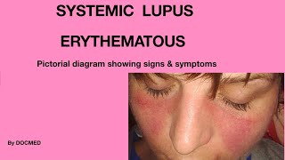 Systemic LUPUS ERYTHEMATOUS [upl. by Eihs]