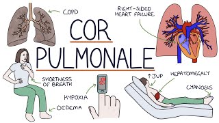 Understanding Cor Pulmonale [upl. by Segalman]