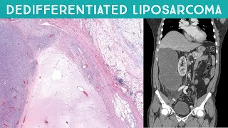 Dedifferentiated Liposarcoma huge retroperitoneal mass near kidney Oregon Case 12 [upl. by Edison577]