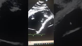 RV Apical Thrombus in DCM Patient [upl. by Derwood]