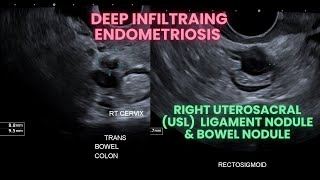 Ultrasound Deep infiltrating endometriosis Bowel nodule and uterosacral ligament nodule [upl. by Llehsram]