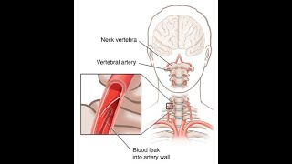 Applied or clinical anatomy of vertebral artery  Occlusion to branches of vertebral artery [upl. by Allina189]