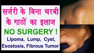 Lipoma Without Surgery चरबी के गाठों का इलाज  Fat Lump Fibrous Tumor Exostosis Cyst Ganglion [upl. by Zetrauq340]