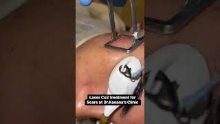 co2 laser treatment for acne scars  DrKasanas Clinic [upl. by Mandie847]