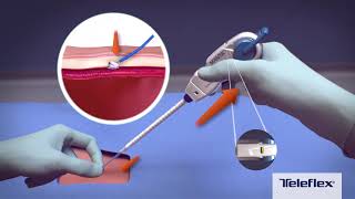 MANTA® Vascular Closure Device Deployment Video [upl. by Ikim]