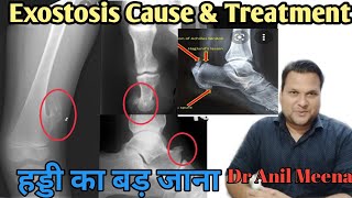 Exostosis Treatment  Exostosis cause and treatment  Osteochndroma  Osteophyte  Osteoma In Hindi [upl. by Ailegna]