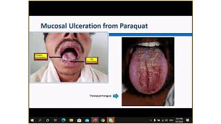 Paraquat poisoning [upl. by Azzil504]