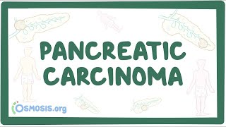 Pancreatic carcinoma  an Osmosis Preview [upl. by Eversole]